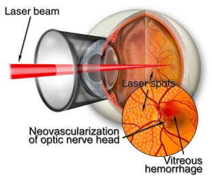 Diabetes and the eye